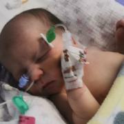Jessie Fawcett, 17 weeks, who suffers from torticollis and plagiocephaly