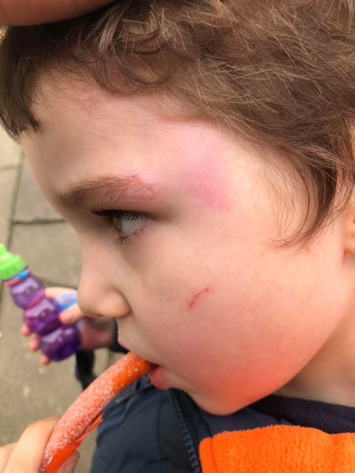 Finley, 4, was left with cuts and bruises to his face