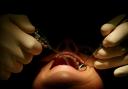 A new survey says that people are not getting dental check-ups due to the cost of living crisis and a shortage of NHS dentists