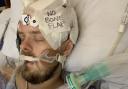 He suffered a traumatic brain injury and was in an induced coma for two weeks