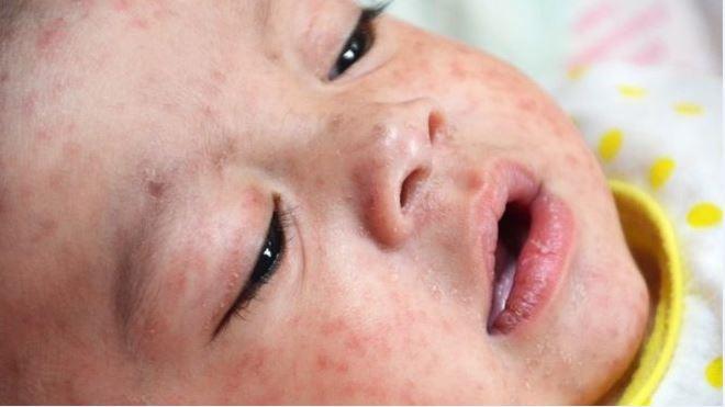 Measles: Brighton and Hove parents urged to check children’s vaccinations Pi News
