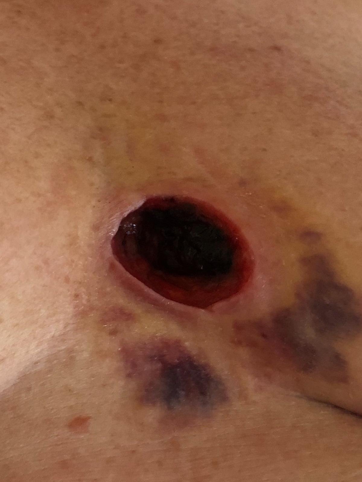 Woman says she was left with gaping hole in chest due to tight